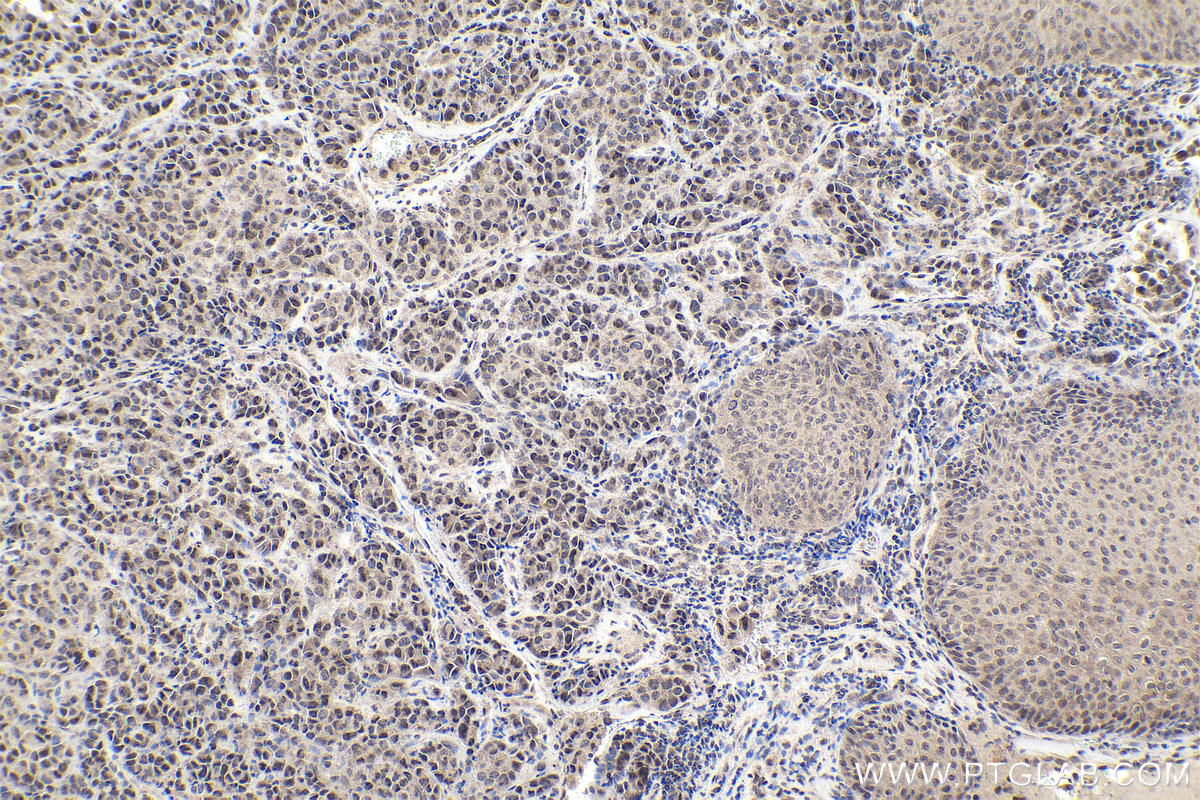 Immunohistochemical analysis of paraffin-embedded human malignant melanoma tissue slide using KHC1937 (ZNF703 IHC Kit).
