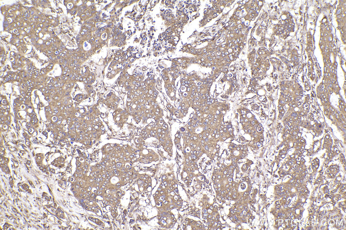 Immunohistochemical analysis of paraffin-embedded human stomach cancer tissue slide using KHC2215 (CALR IHC Kit).