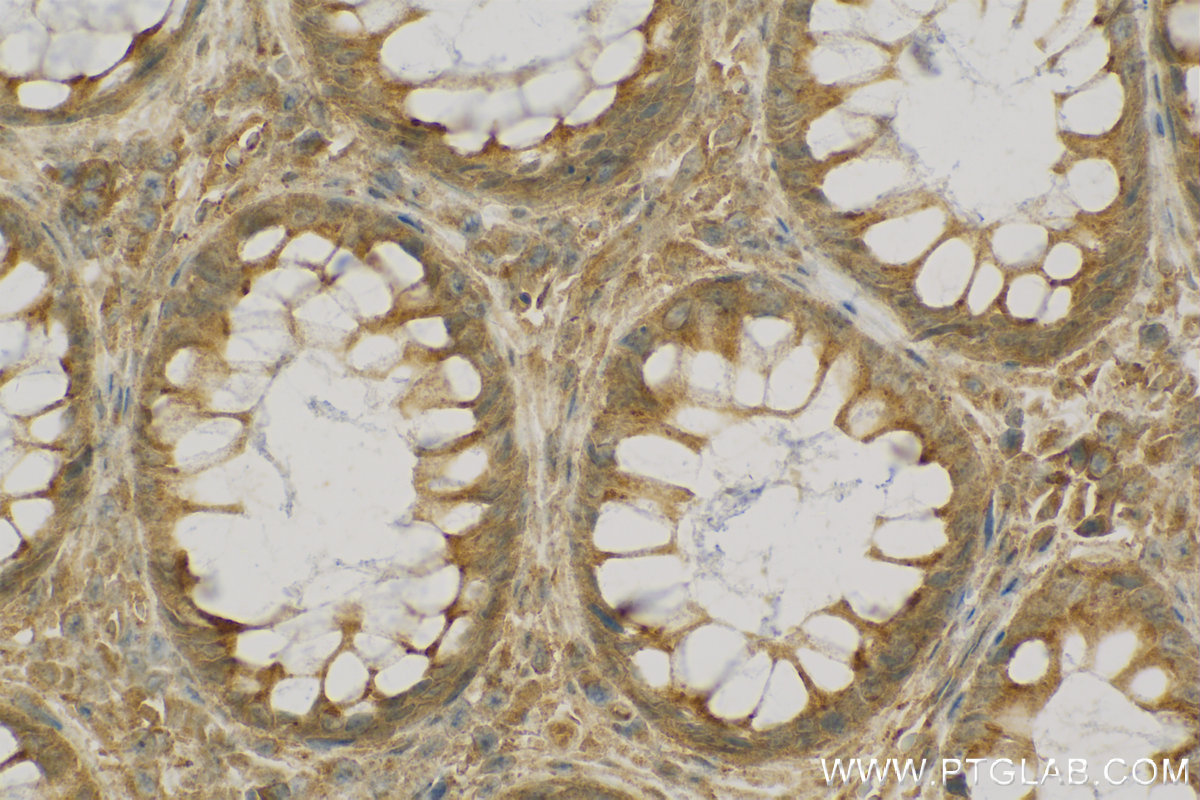 Immunohistochemistry (IHC) staining of human colon cancer tissue using IHH Polyclonal antibody (13388-1-AP)