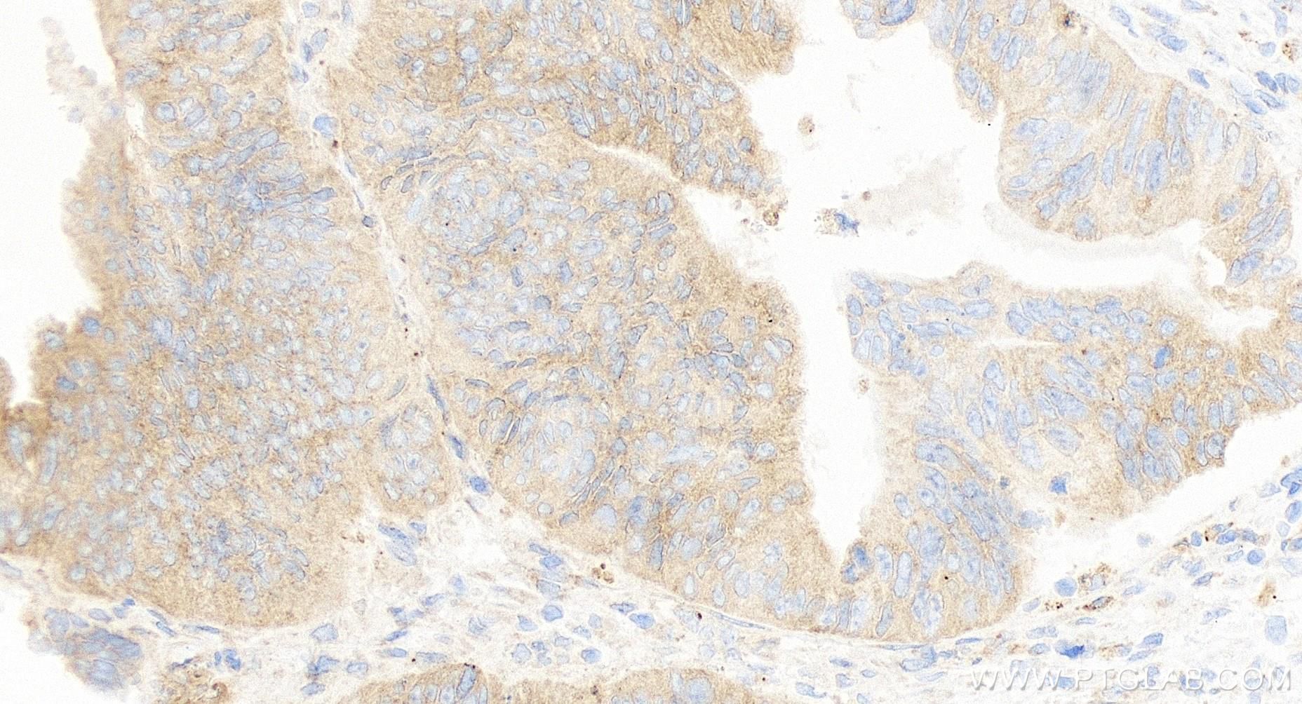 Immunohistochemistry (IHC) staining of human colon cancer tissue using IL-1 alpha Recombinant antibody (84411-5-RR)