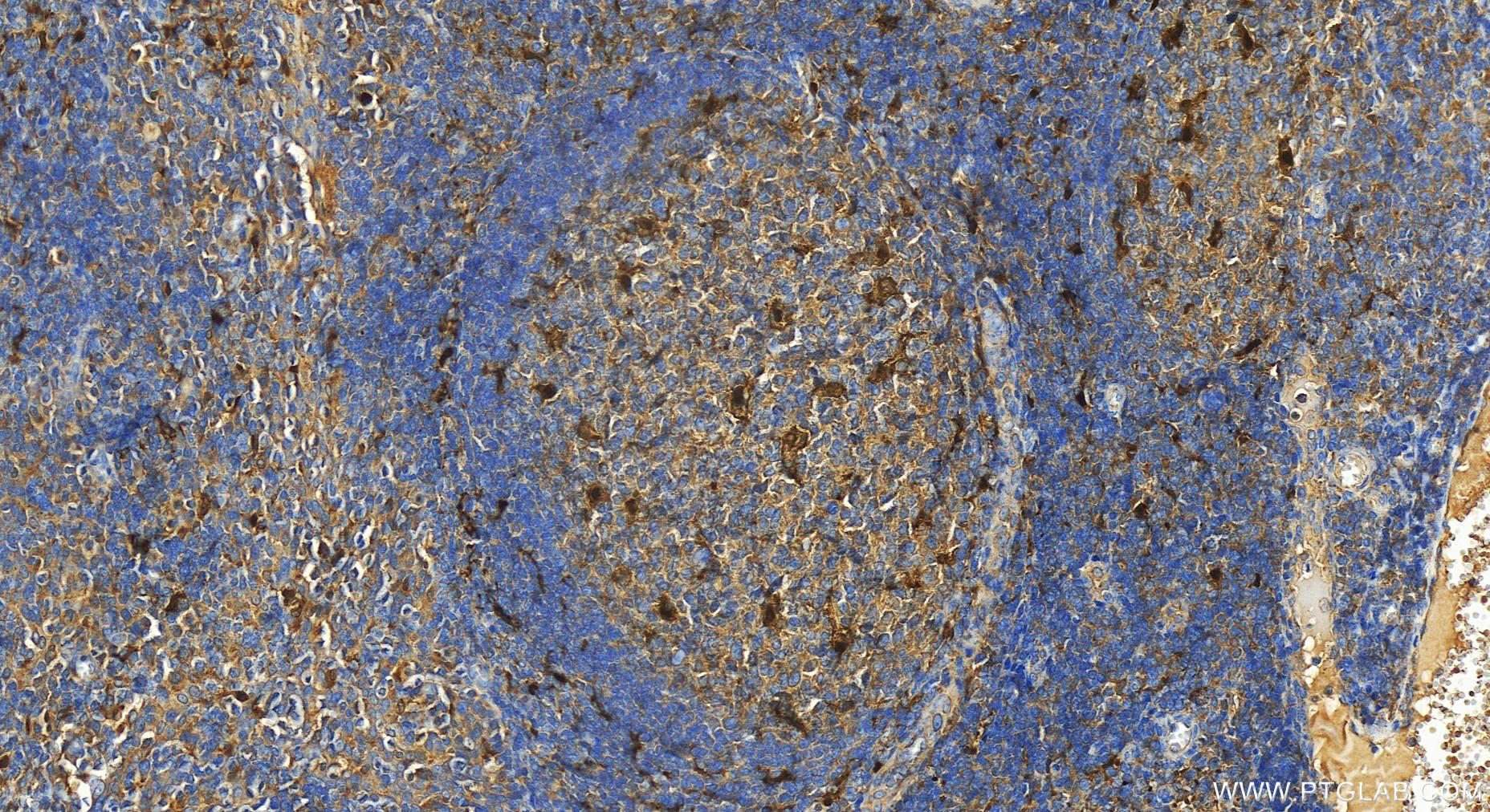 Immunohistochemistry (IHC) staining of human tonsillitis tissue using IL-18 Recombinant antibody (82907-1-RR)