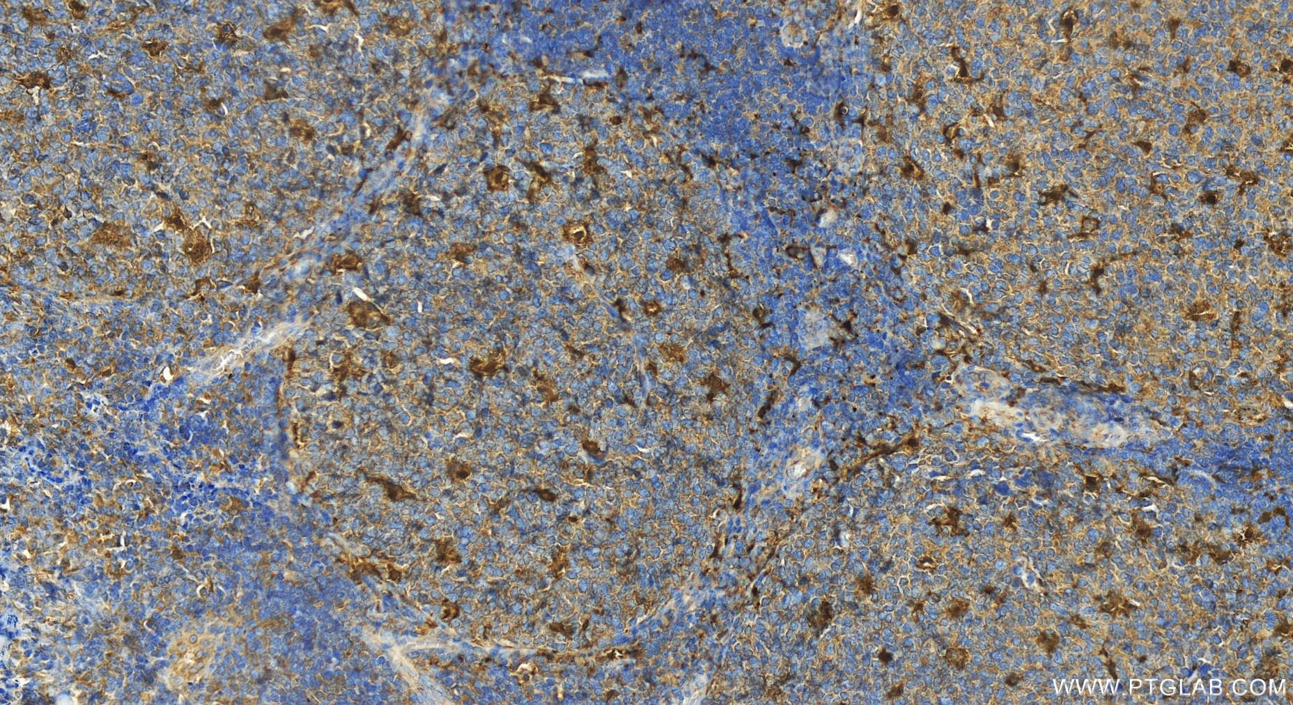 Immunohistochemistry (IHC) staining of human tonsillitis tissue using IL-18 Recombinant antibody (82907-1-RR)