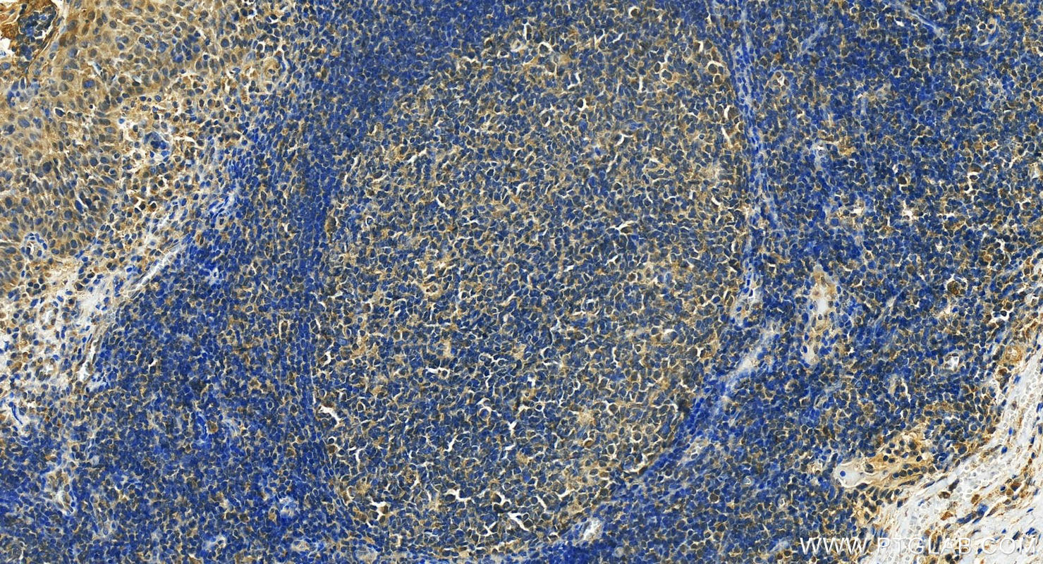 Immunohistochemistry (IHC) staining of human tonsillitis tissue using IL-1F6/IL-36 Alpha Polyclonal antibody (24173-1-AP)