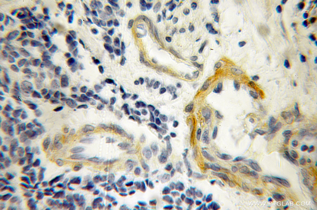 Immunohistochemistry (IHC) staining of human lung cancer tissue using IL-15 Polyclonal antibody (12962-1-AP)