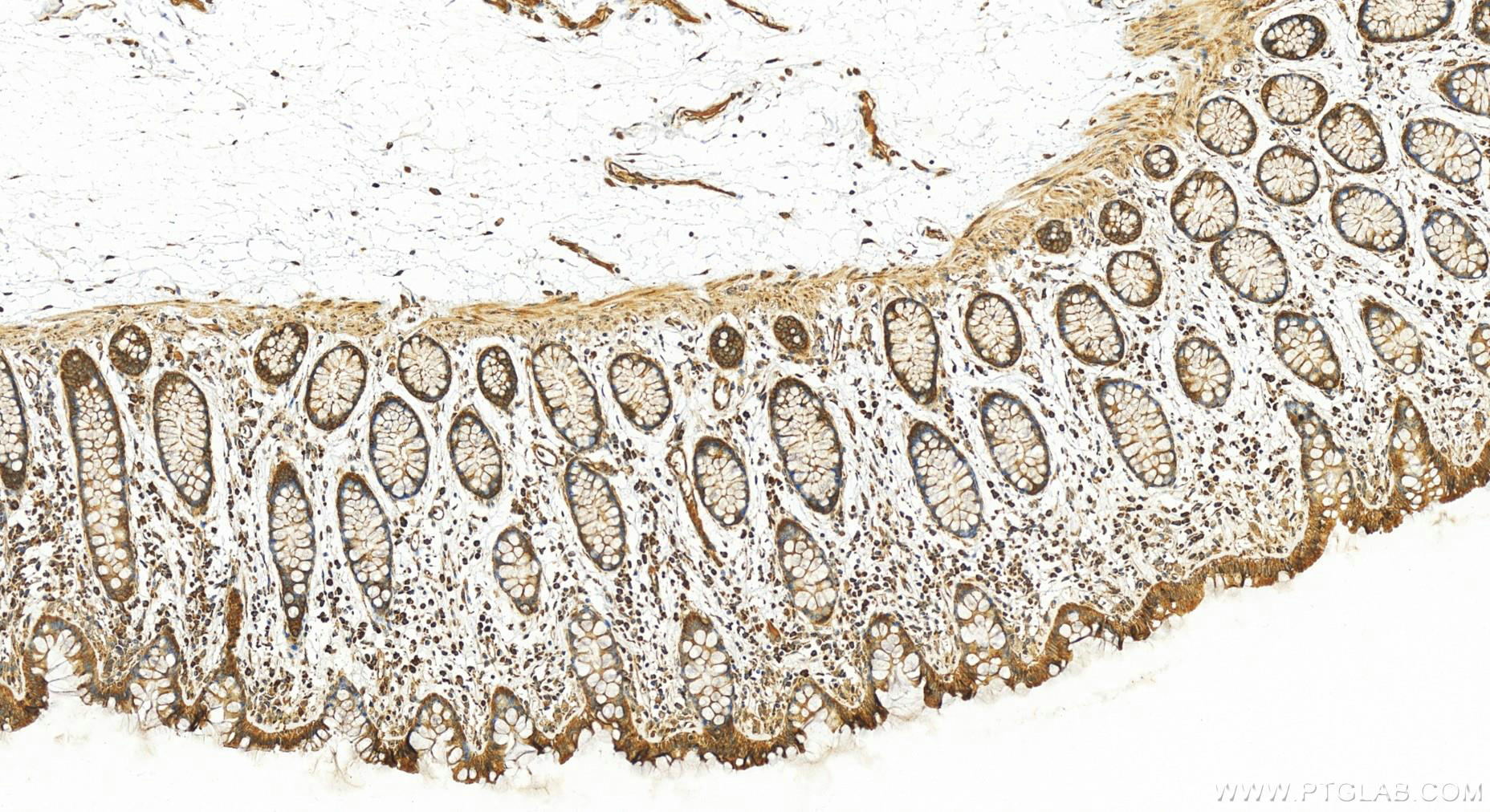 Immunohistochemistry (IHC) staining of human colon tissue using IL-17RB Polyclonal antibody (20673-1-AP)