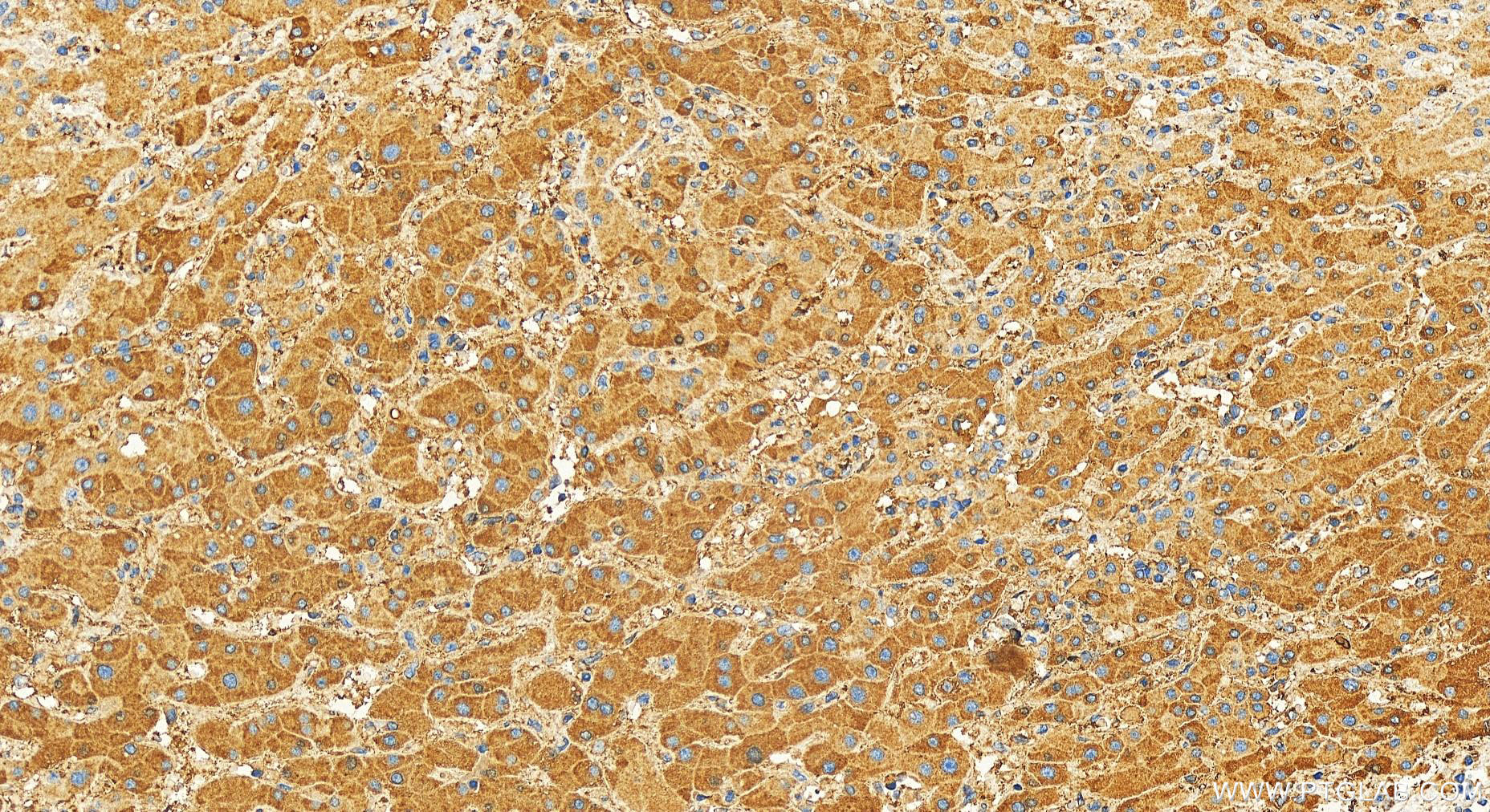 Immunohistochemistry (IHC) staining of human intrahepatic cholangiocarcinoma tissue using IL-1RAP Polyclonal antibody (30966-1-AP)