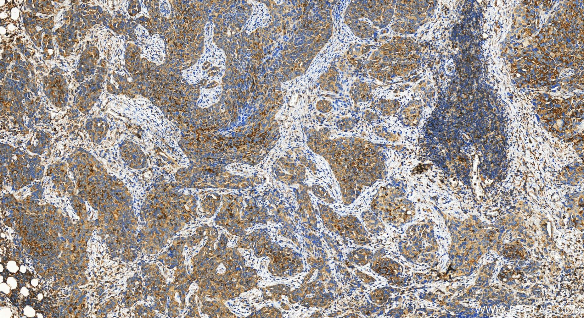 Immunohistochemistry (IHC) staining of human ovary cancer tissue using IL-1RAP Polyclonal antibody (30966-1-AP)