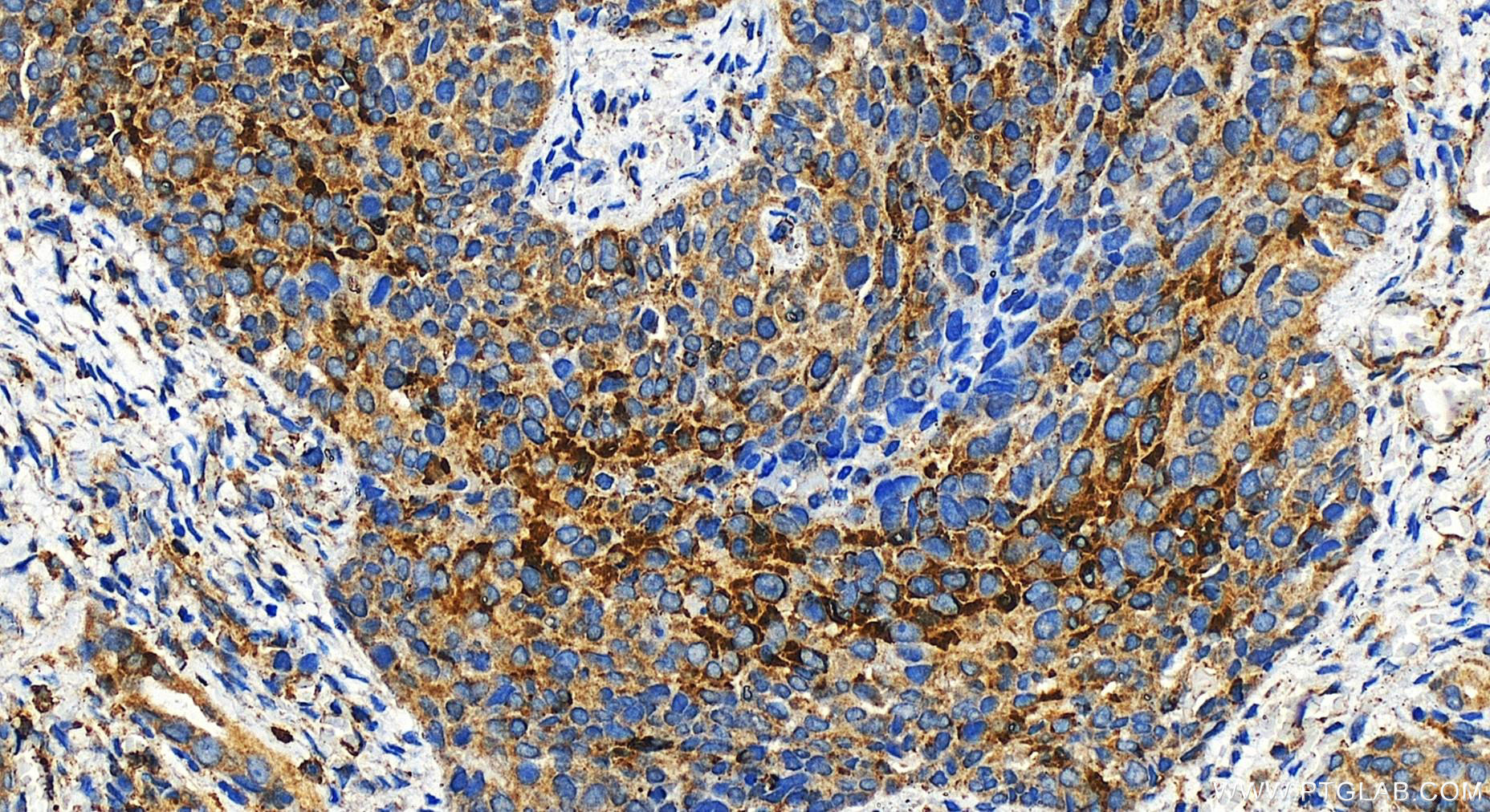 Immunohistochemistry (IHC) staining of human ovary cancer tissue using IL-1RAP Polyclonal antibody (30966-1-AP)