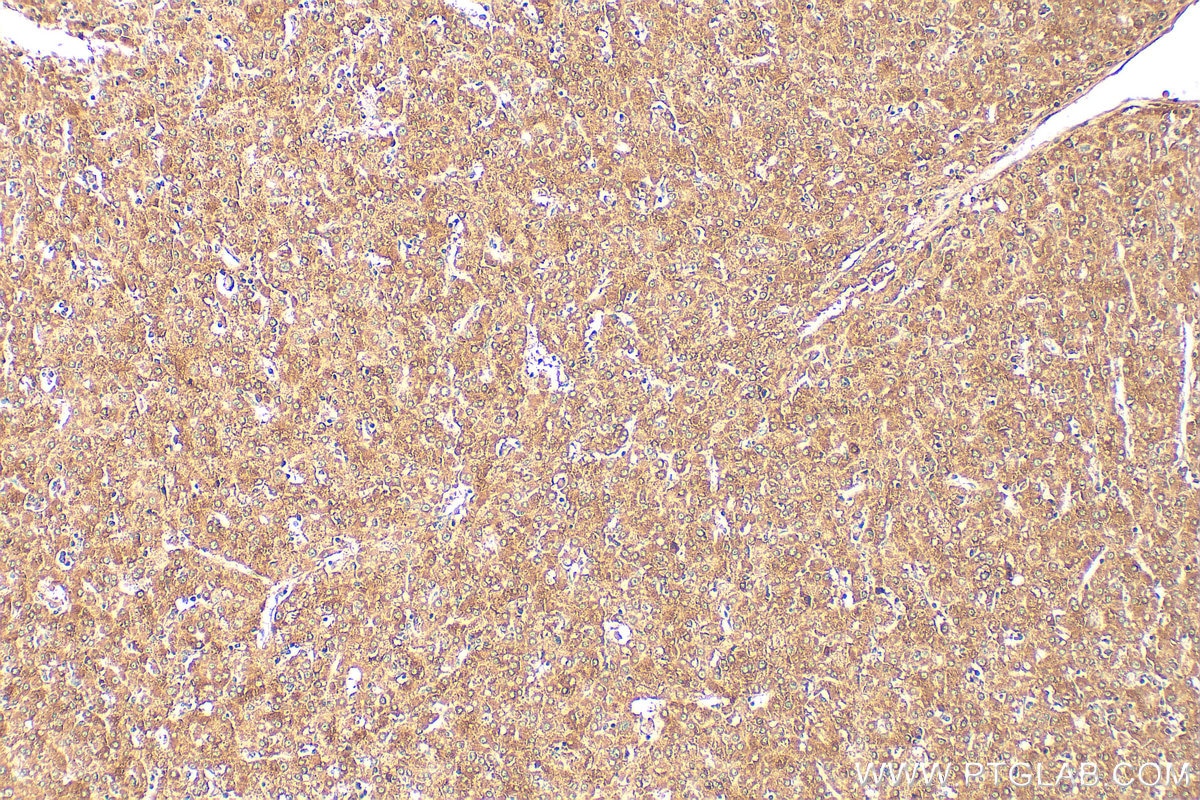 Immunohistochemistry (IHC) staining of human liver cancer tissue using IL-33 Polyclonal antibody (12372-1-AP)