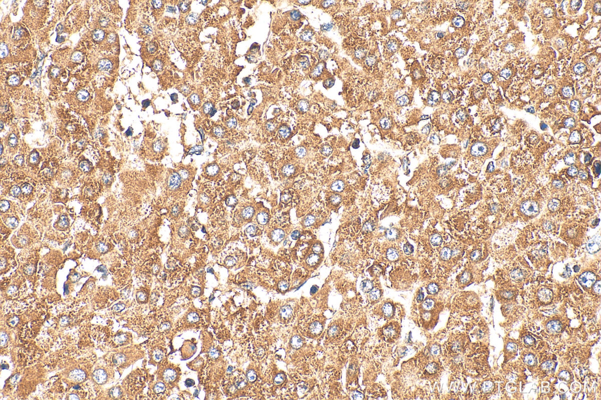 Immunohistochemistry (IHC) staining of human liver cancer tissue using IL-33 Polyclonal antibody (12372-1-AP)