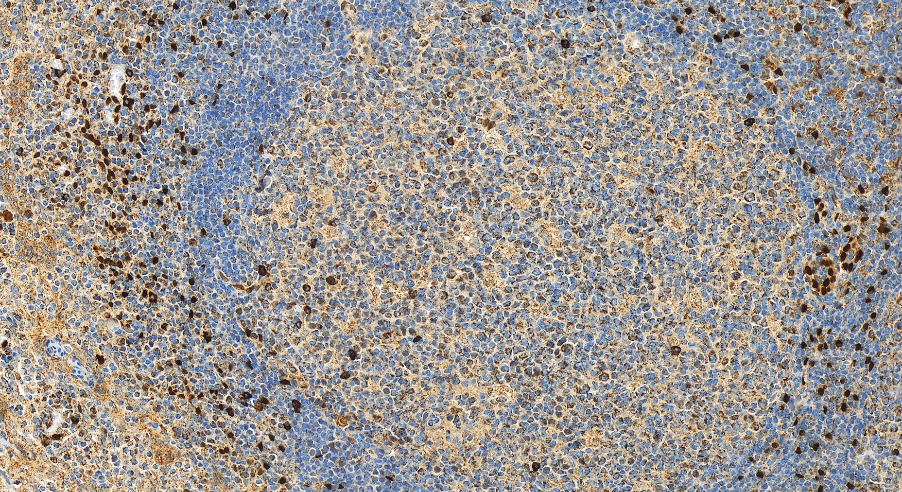 Immunohistochemistry (IHC) staining of human tonsillitis tissue using IL-33 Polyclonal antibody (12372-1-AP)