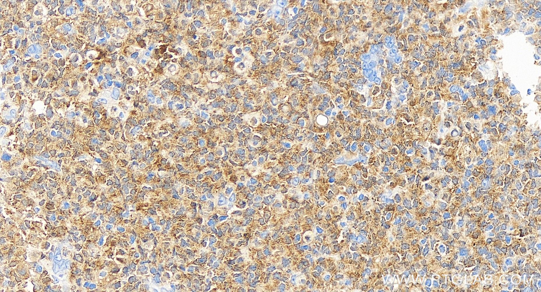 Immunohistochemistry (IHC) staining of human tonsillitis tissue using IL3RA/CD123 Recombinant antibody (83243-3-RR)