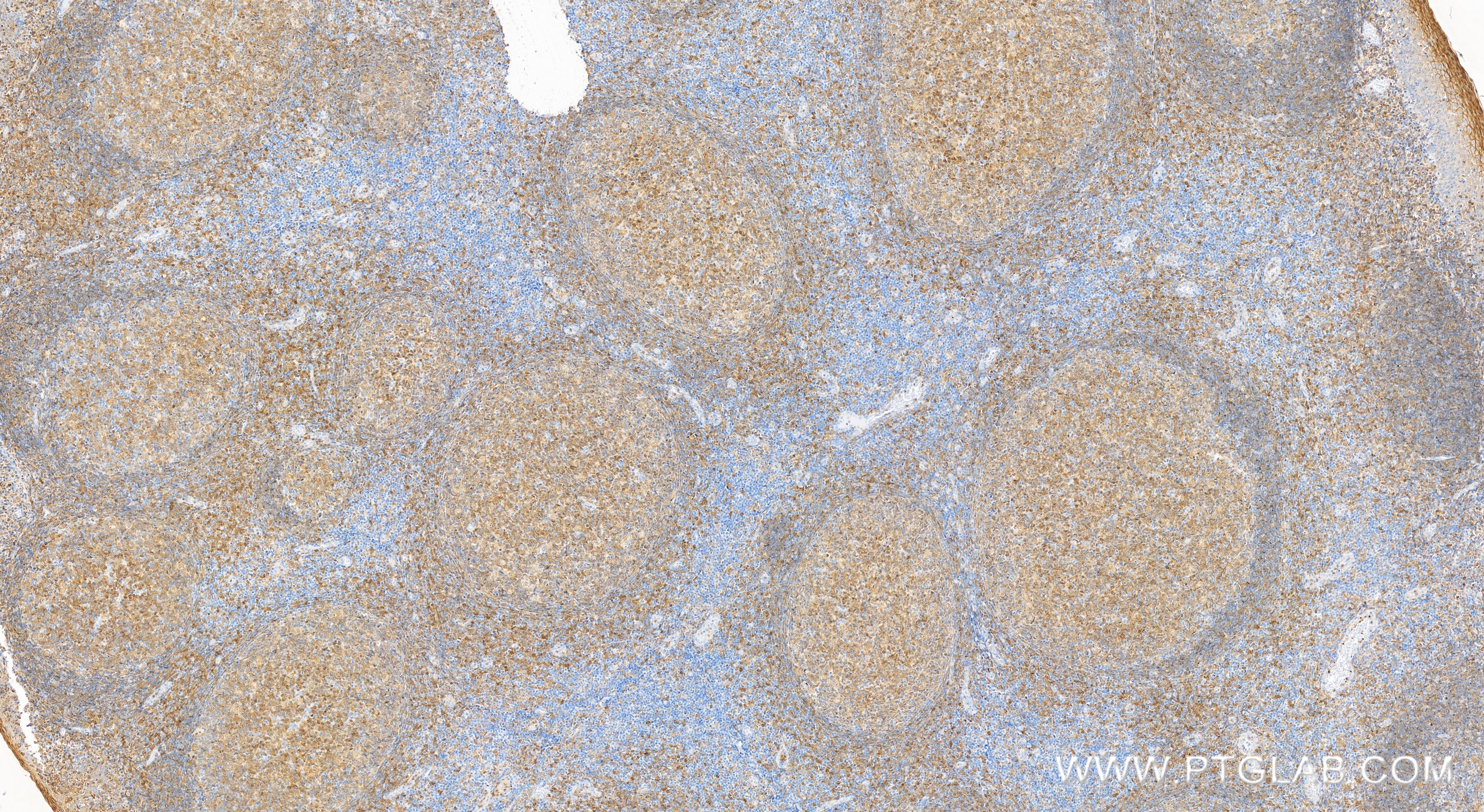 Immunohistochemistry (IHC) staining of human tonsillitis tissue using IL3RA/CD123 Recombinant antibody (83243-3-RR)