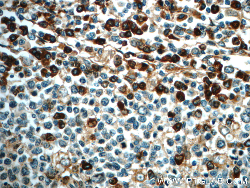 IHC staining of paraffin-embedded human tonsillitis slide using IL6 antibody (21865-1-AP) at a dilution of 1:50