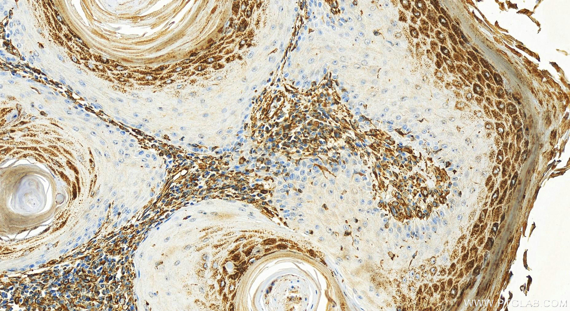 Immunohistochemistry (IHC) staining of human skin cancer tissue using ILK Monoclonal antibody (67724-1-Ig)