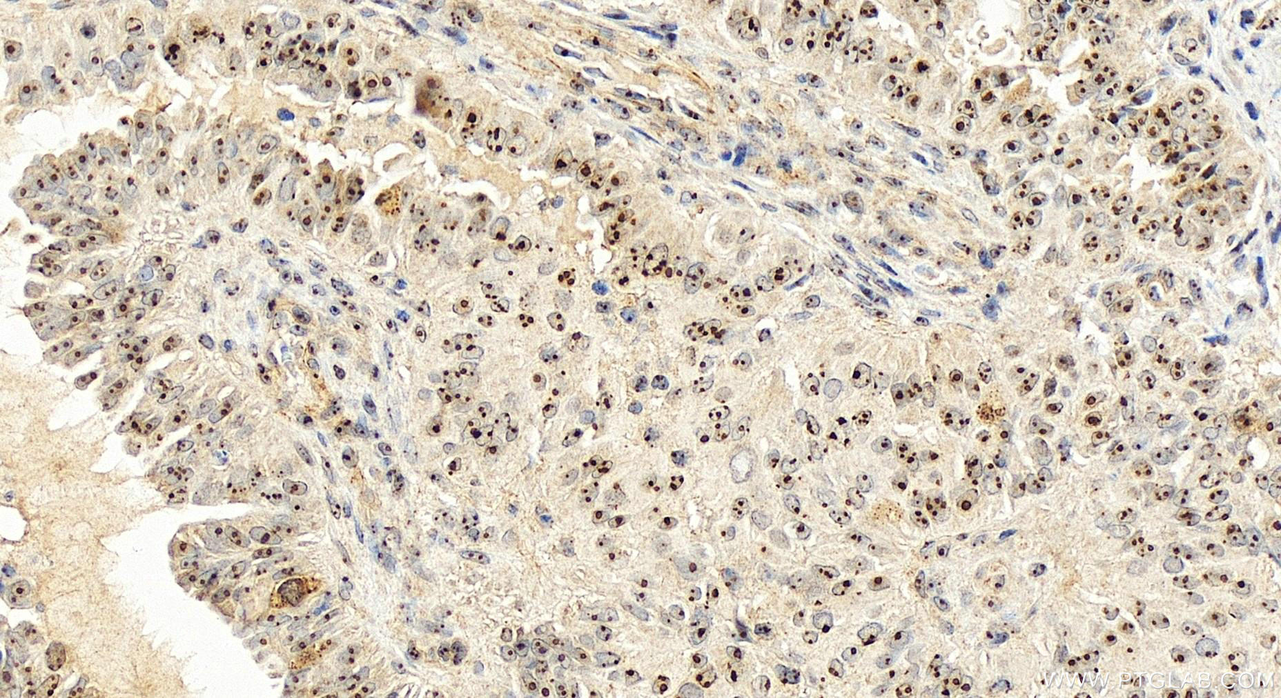 Immunohistochemistry (IHC) staining of human ovary cancer tissue using IMP4 Polyclonal antibody (16205-1-AP)