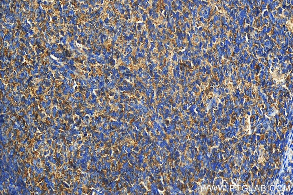 Immunohistochemistry (IHC) staining of human tonsillitis tissue using IMPDH1 Polyclonal antibody (22092-1-AP)