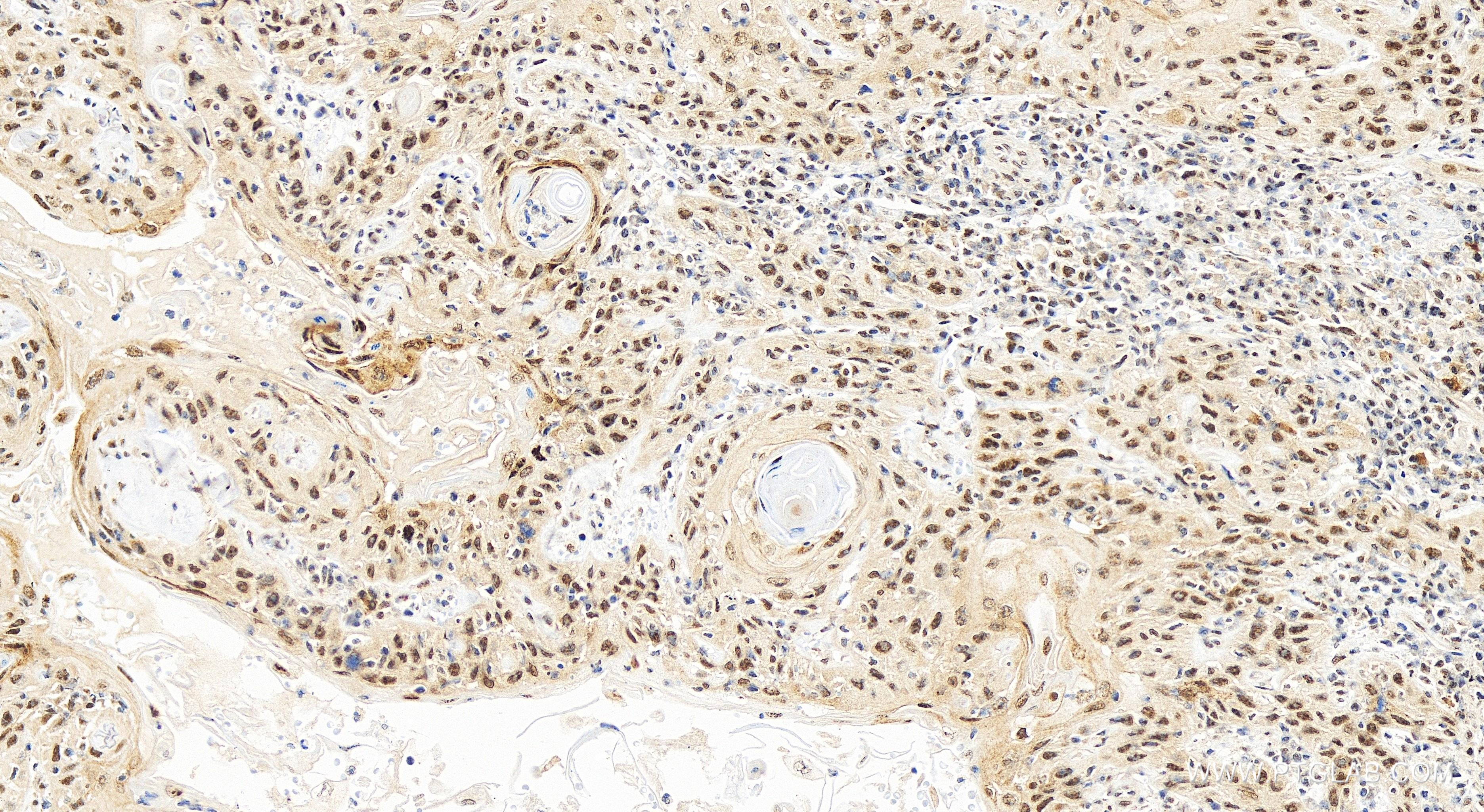 Immunohistochemistry (IHC) staining of human skin cancer tissue using IMUP Recombinant antibody (84148-6-RR)