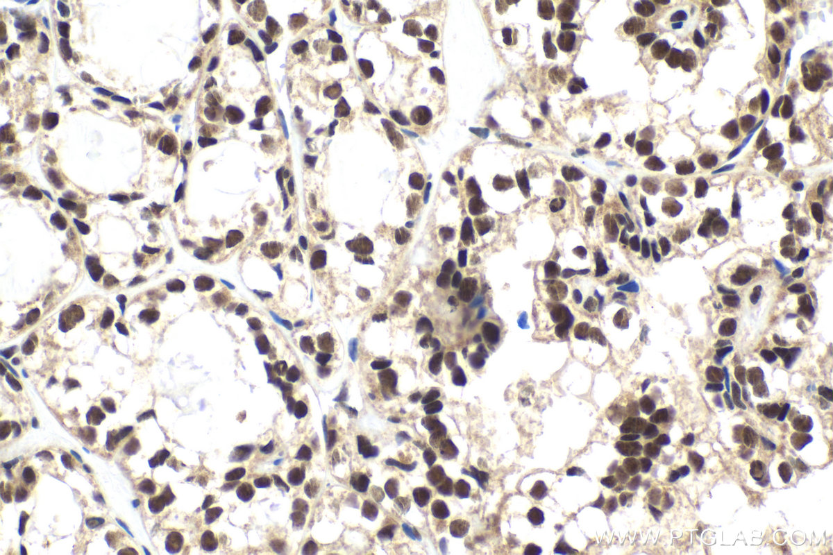 Immunohistochemistry (IHC) staining of human thyroid cancer tissue using ING4 Polyclonal antibody (10617-1-AP)