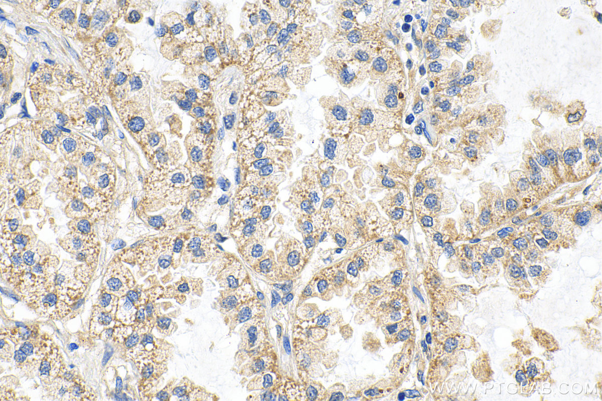 Immunohistochemistry (IHC) staining of human lung cancer tissue using INPP4B Polyclonal antibody (15890-1-AP)