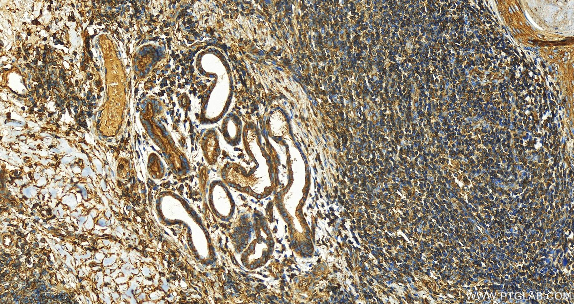 Immunohistochemistry (IHC) staining of human skin cancer tissue using IQGAP1 Monoclonal antibody (68588-1-Ig)