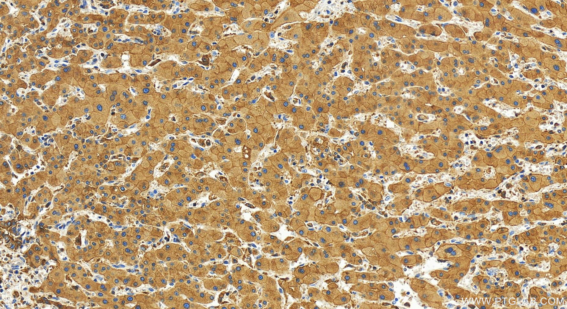 Immunohistochemistry (IHC) staining of human intrahepatic cholangiocarcinoma tissue using IQGAP2 Polyclonal antibody (30692-1-AP)