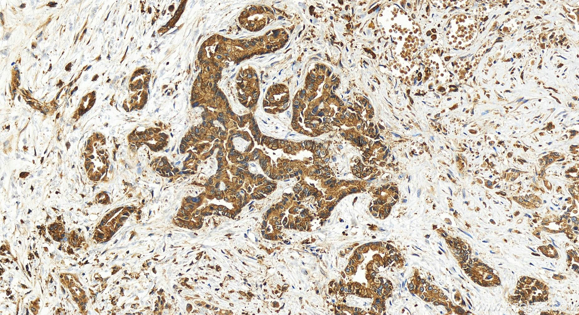 Immunohistochemistry (IHC) staining of human intrahepatic cholangiocarcinoma tissue using IQGAP2 Polyclonal antibody (30692-1-AP)