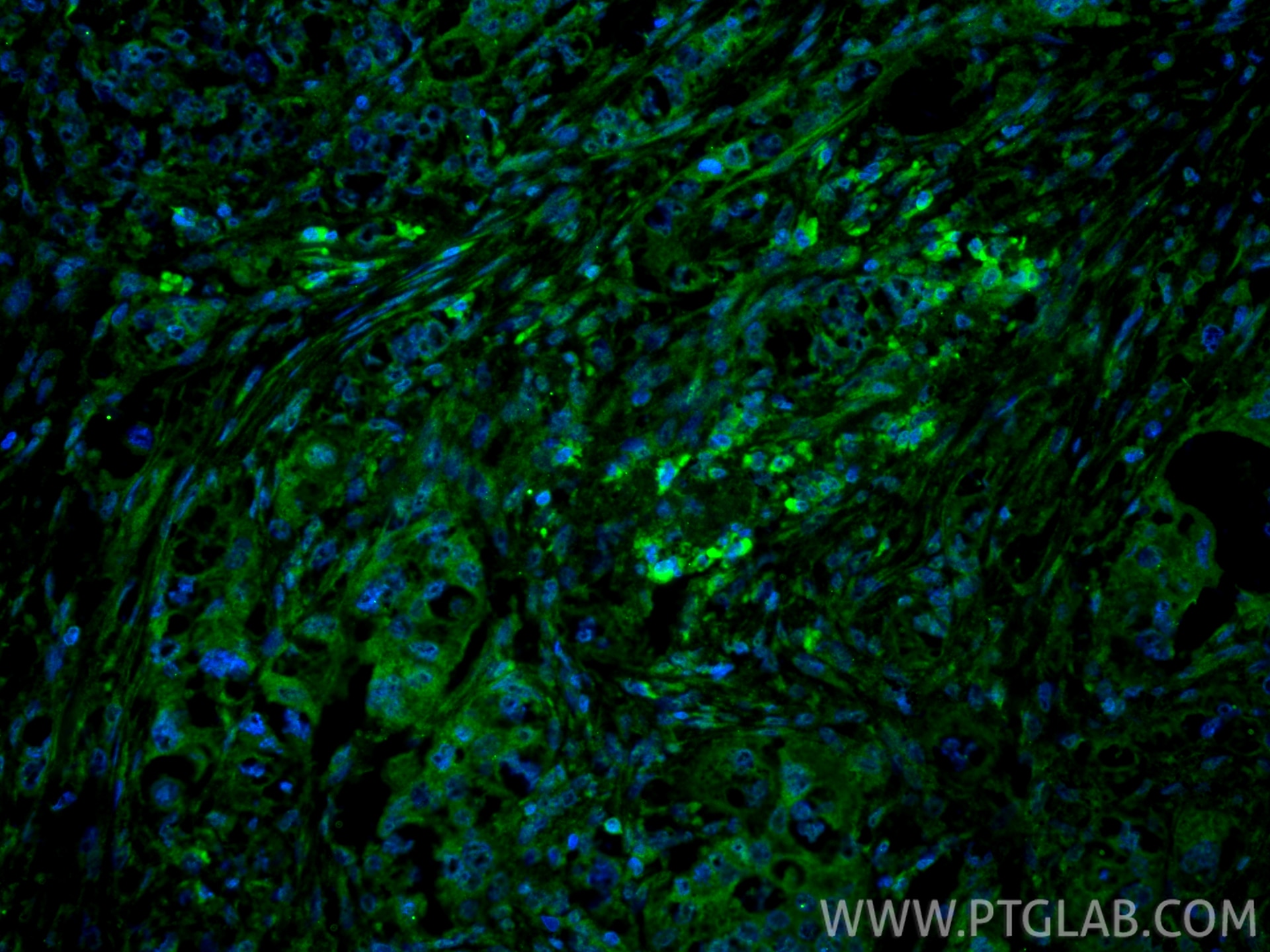 Immunofluorescence (IF) / fluorescent staining of human lung cancer tissue using IRAK4 Polyclonal antibody (18221-1-AP)