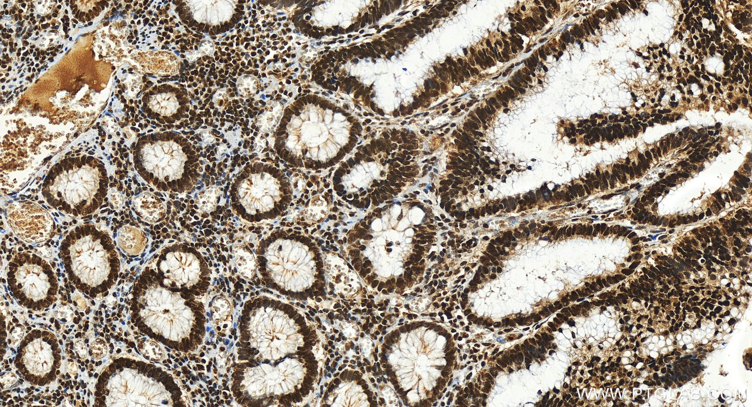 Immunohistochemistry (IHC) staining of human colon cancer tissue using IRF2 Polyclonal antibody (12525-1-AP)