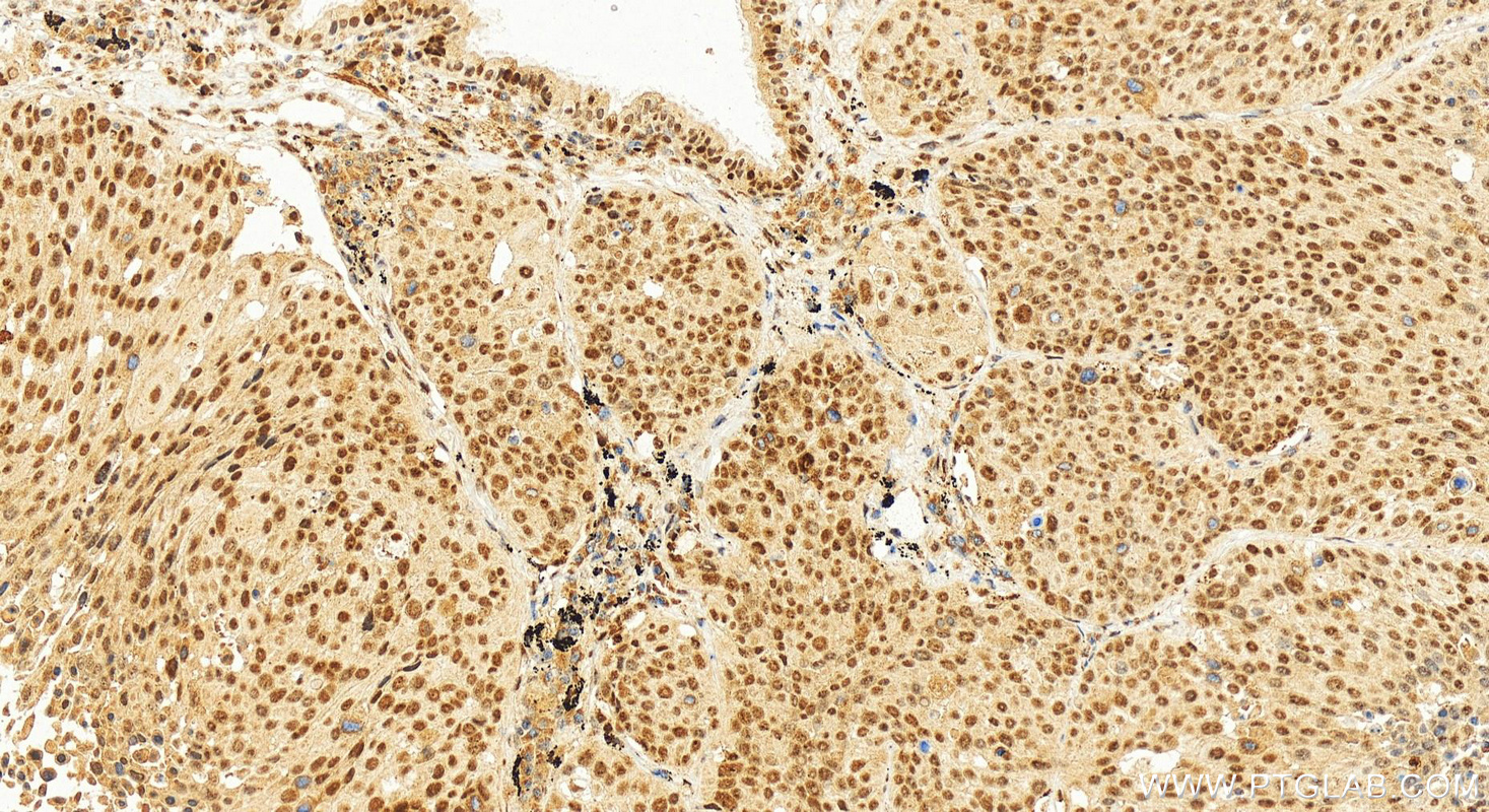 Immunohistochemistry (IHC) staining of human lung squamous cell carcinoma tissue using IRF2BP2 Polyclonal antibody (18847-1-AP)