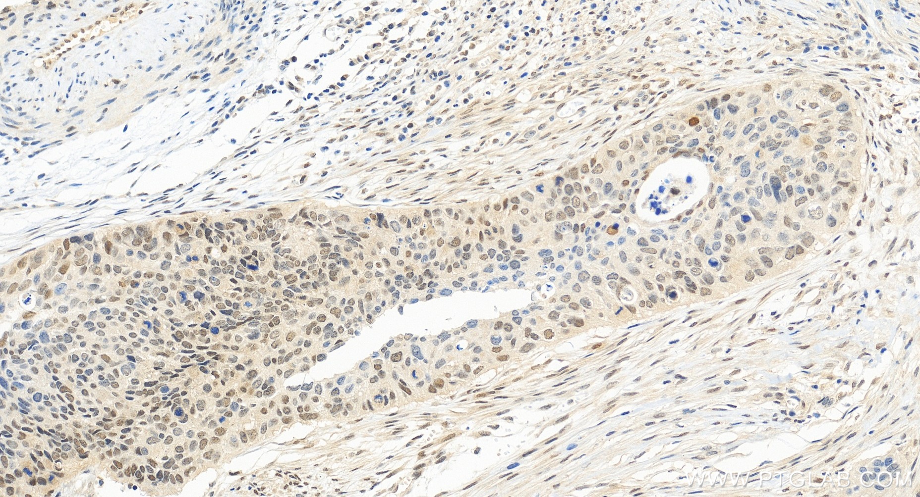 Immunohistochemistry (IHC) staining of human cervical cancer tissue using IRF9 Recombinant antibody (85160-2-RR)