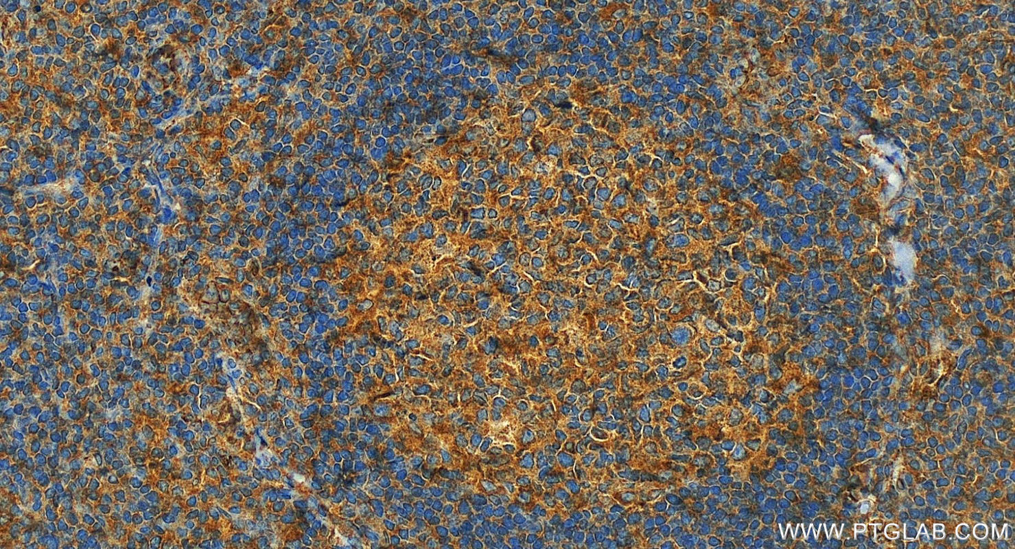 Immunohistochemistry (IHC) staining of human tonsillitis tissue using Integrin Alpha 4 Polyclonal antibody (19676-1-AP)