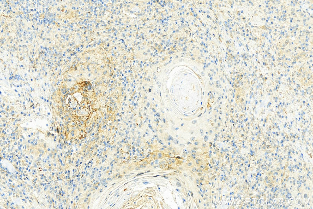 Immunohistochemistry (IHC) staining of human skin cancer tissue using Integrin Alpha-5 Polyclonal antibody (10569-1-AP)