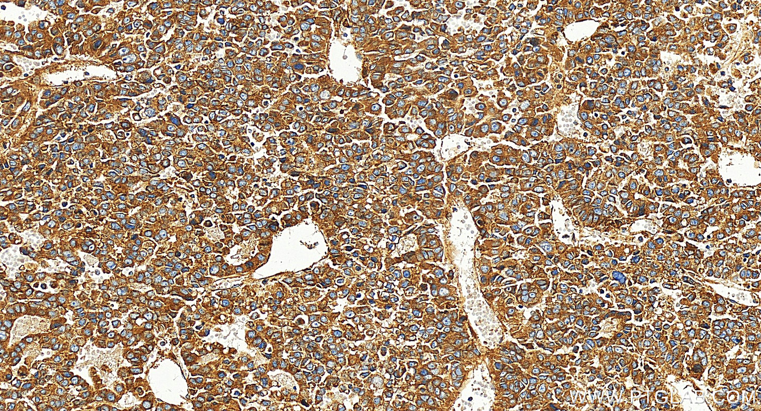 Immunohistochemistry (IHC) staining of human Hepatocellular carcinoma using Integrin Alpha V Polyclonal antibody (27096-1-AP)