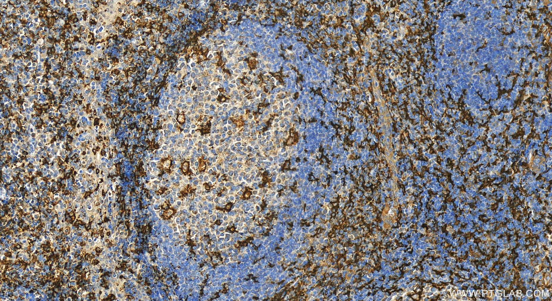 Immunohistochemistry (IHC) staining of human tonsillitis tissue using CD11c/Integrin Alpha X Polyclonal antibody (17342-1-AP)