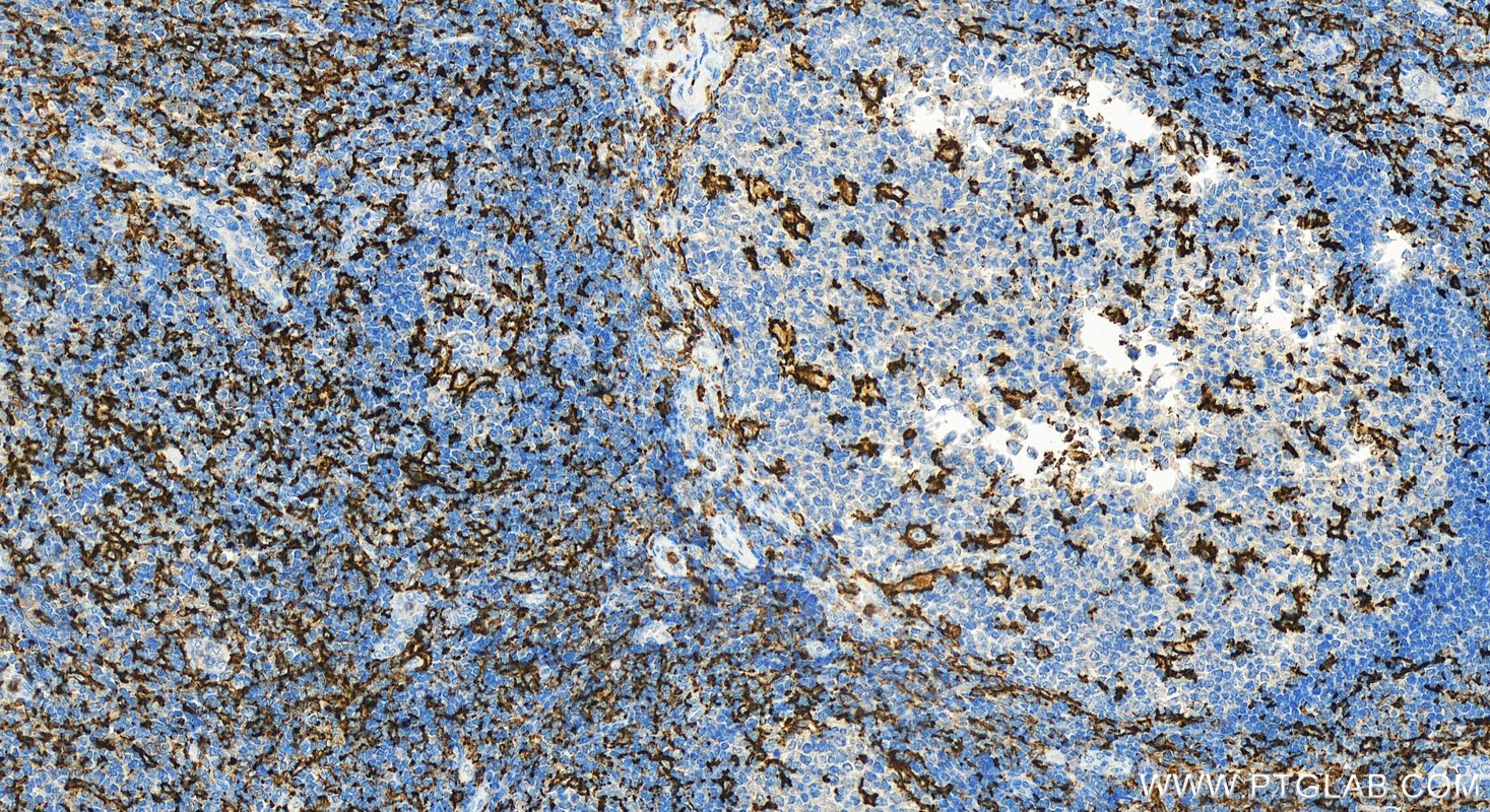 Immunohistochemistry (IHC) staining of human tonsillitis tissue using CD11c/Integrin Alpha X Polyclonal antibody (17342-1-AP)