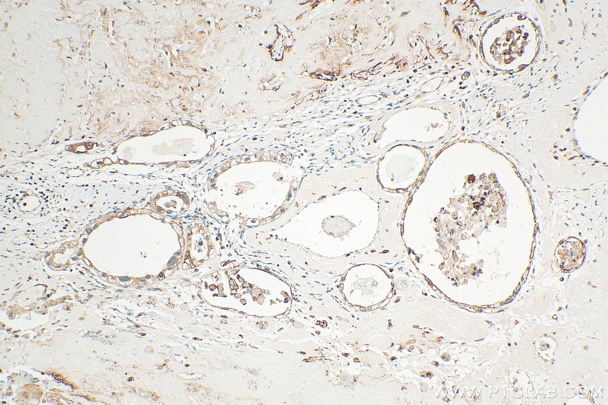 Immunohistochemistry (IHC) staining of human ovary tumor tissue using Integrin Beta 6 Polyclonal antibody (21703-1-AP)