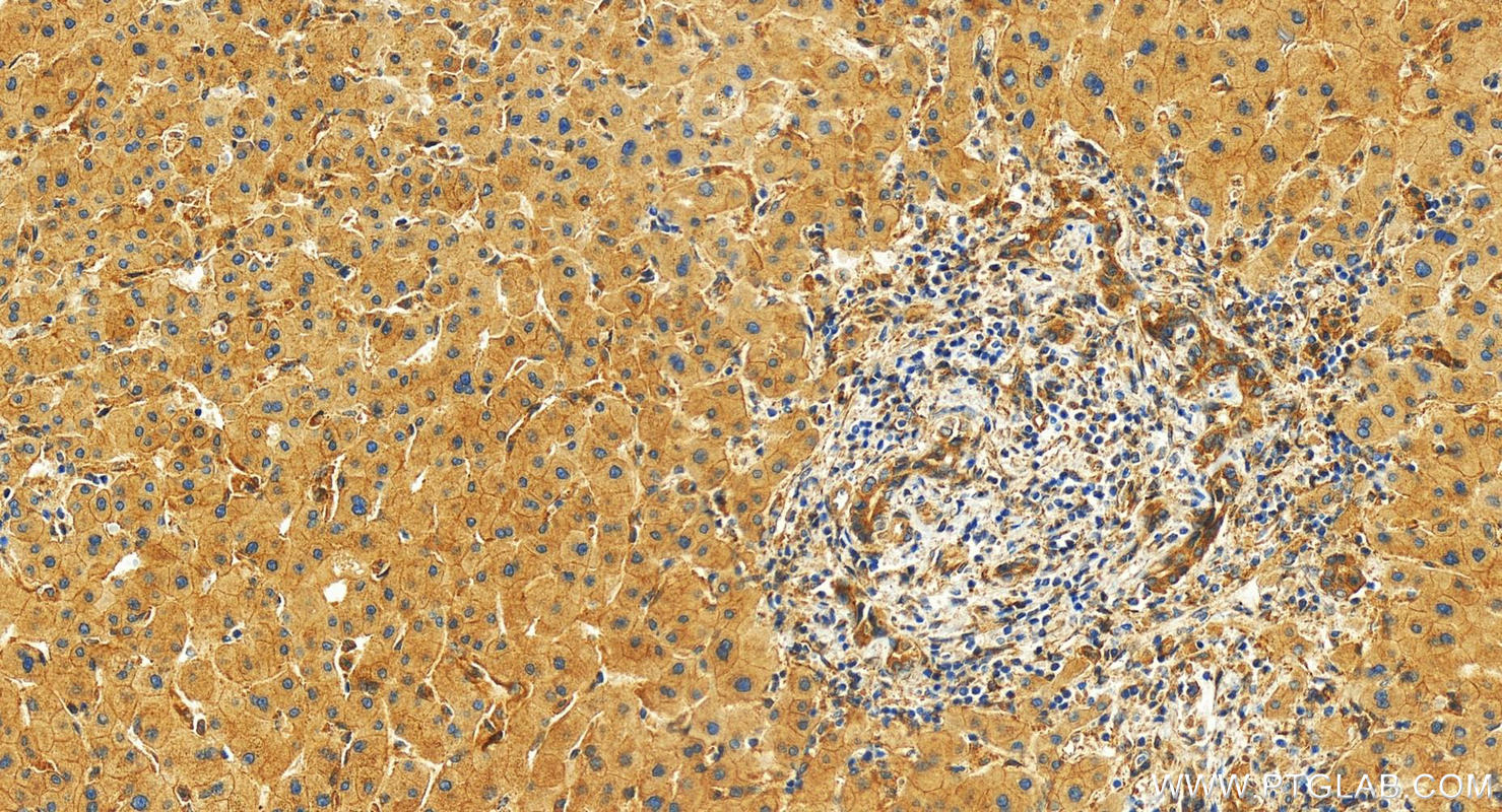 Immunohistochemistry (IHC) staining of human intrahepatic cholangiocarcinoma tissue using Intersectin 1 Polyclonal antibody (21862-1-AP)