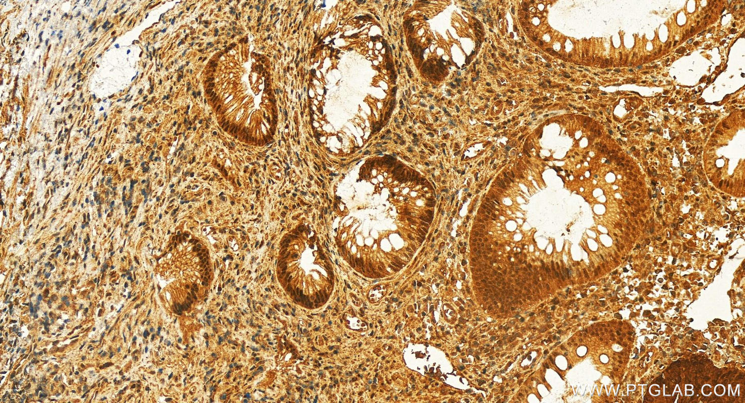 Immunohistochemistry (IHC) staining of human colon cancer using Icln Polyclonal antibody (25964-1-AP)