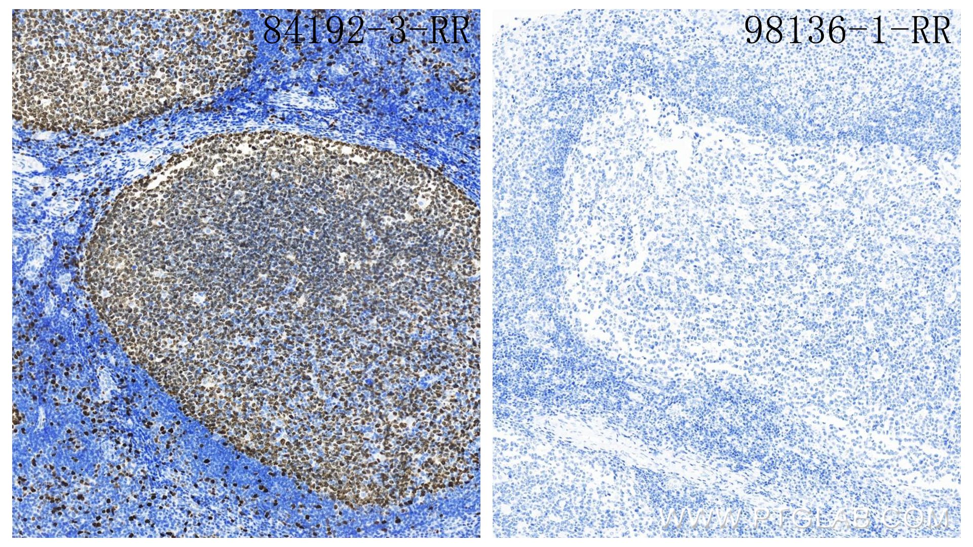 Immunohistochemistry (IHC) staining of human tonsillitis tissue using Rabbit IgG Isotype Control Recombinant Antibody (98136-1-RR)