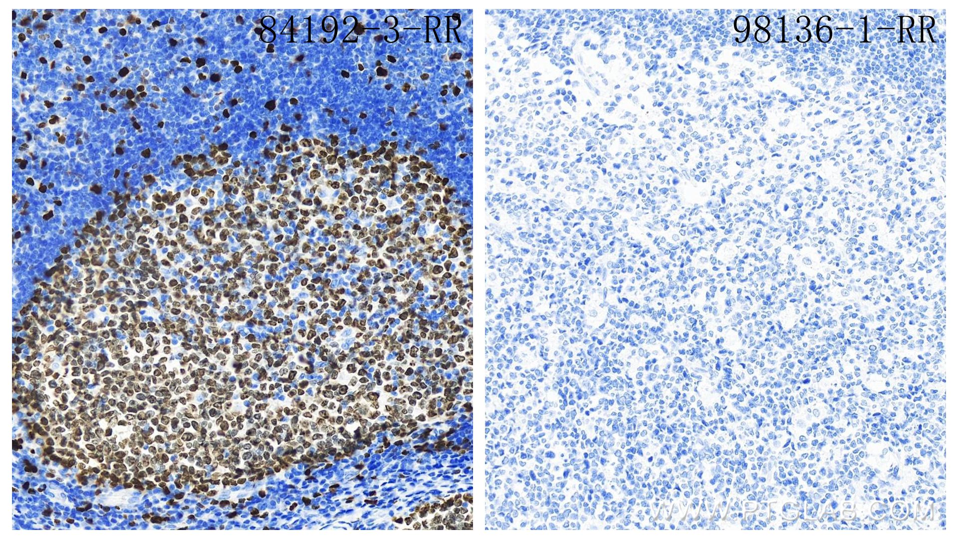 Immunohistochemistry (IHC) staining of human tonsillitis tissue using Rabbit IgG Isotype Control Recombinant Antibody (98136-1-RR)