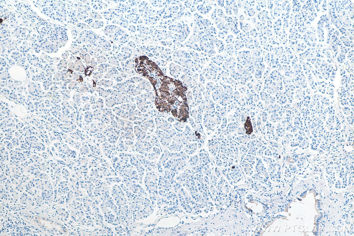 Immunohistochemistry (IHC) staining of human pancreas cancer tissue using INS Monoclonal antibody (66198-1-Ig)