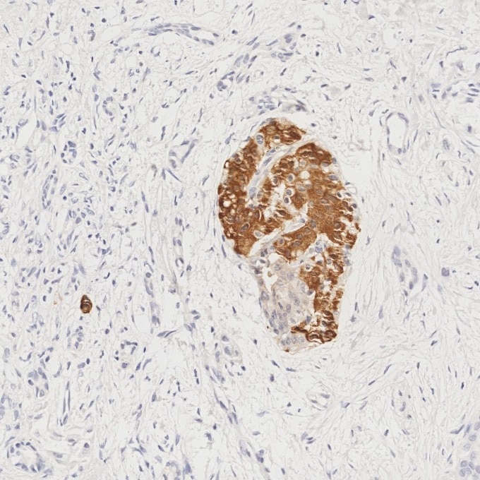Immunohistochemistry (IHC) staining of human pancreas cancer tissue using INS Monoclonal antibody (66198-1-Ig)