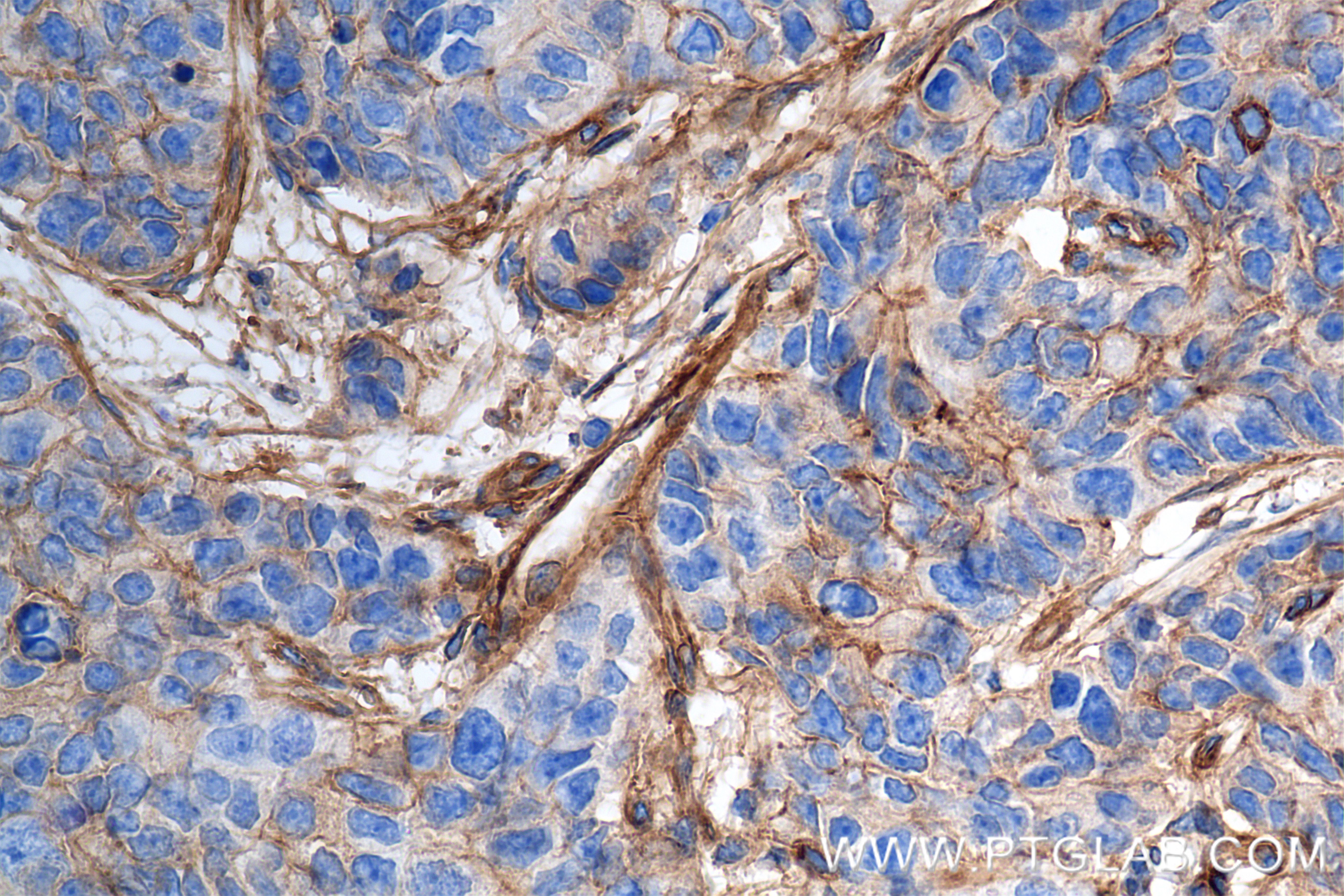 Immunohistochemistry (IHC) staining of human stomach cancer tissue using Integrin Alpha V Recombinant antibody (84883-5-RR)