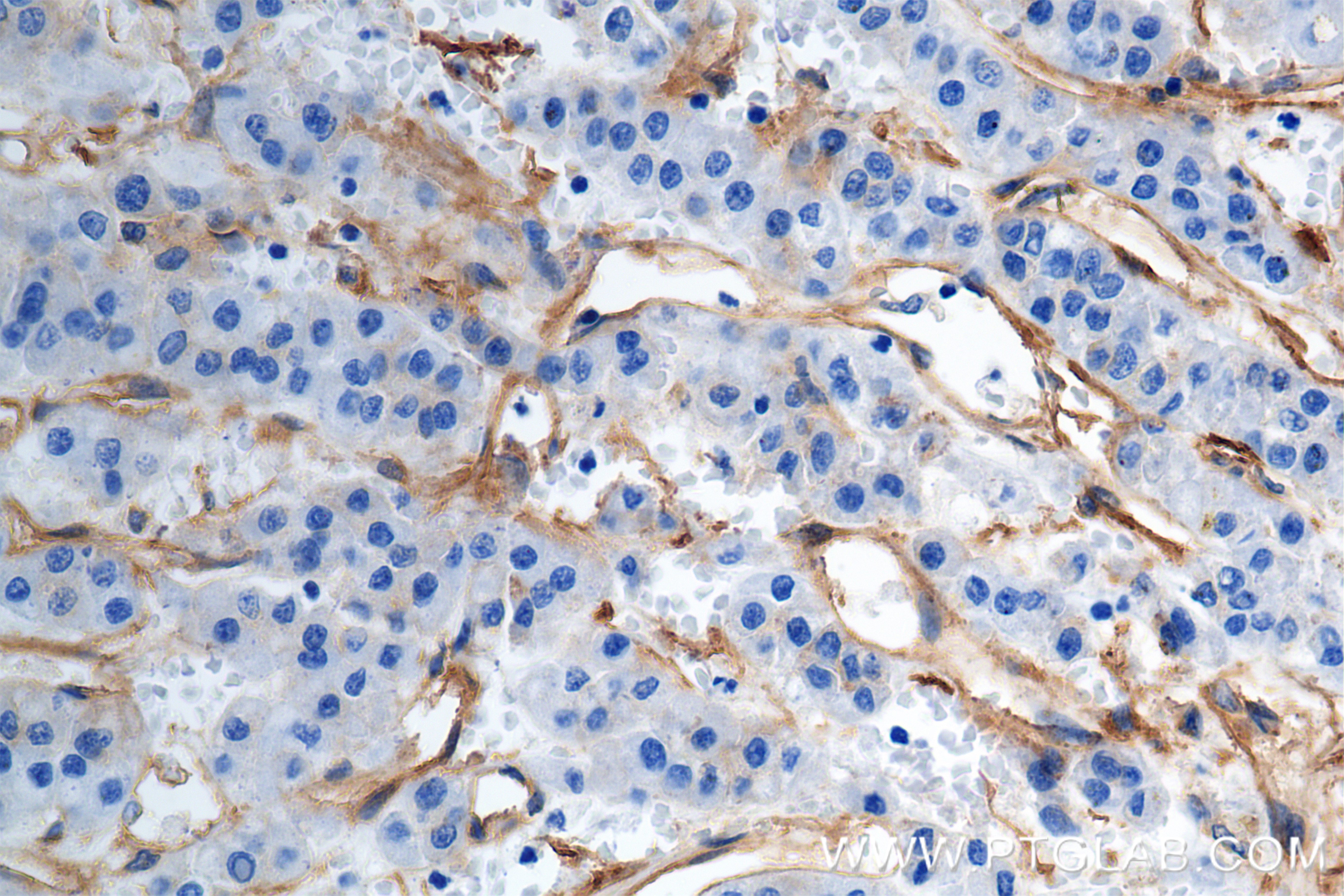 Immunohistochemistry (IHC) staining of human hepatocellular cancer using Integrin Alpha V Recombinant antibody (84883-5-RR)