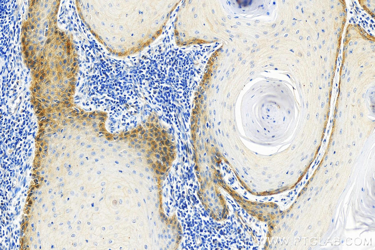 Immunohistochemistry (IHC) staining of human skin cancer tissue using Integrin Beta 4 Monoclonal antibody (66922-2-Ig)