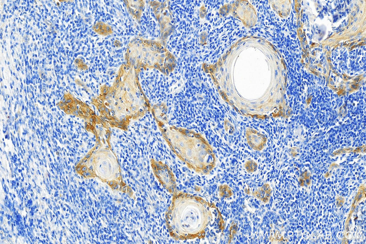 Immunohistochemistry (IHC) staining of human skin cancer tissue using Integrin Beta 4 Monoclonal antibody (66922-2-Ig)