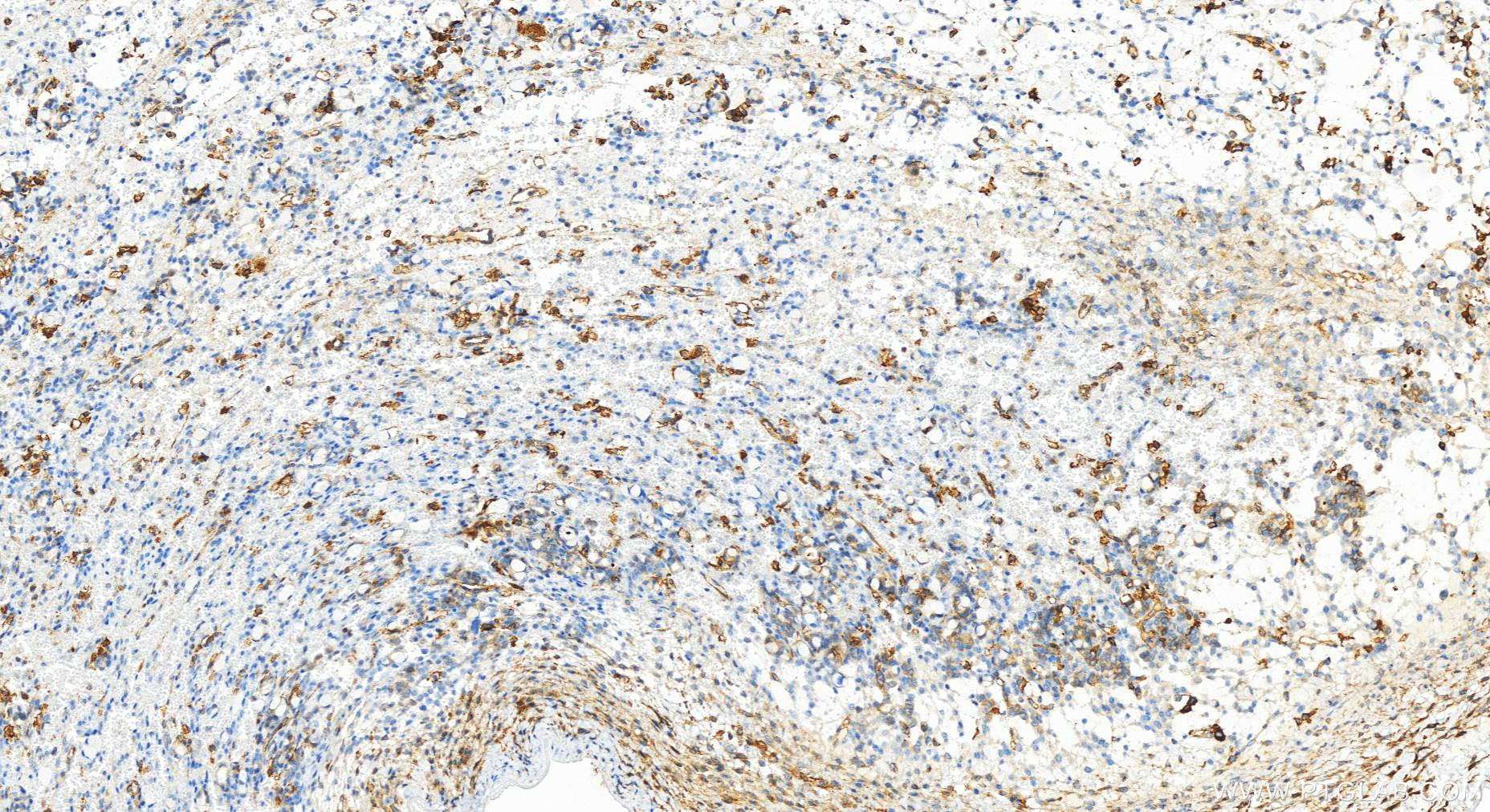 Immunohistochemistry (IHC) staining of human ovary cancer tissue using Integrin beta-5 Recombinant antibody (83514-3-RR)