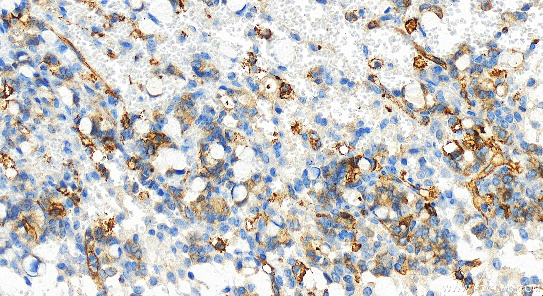 Immunohistochemistry (IHC) staining of human ovary cancer tissue using Integrin beta-5 Recombinant antibody (83514-3-RR)