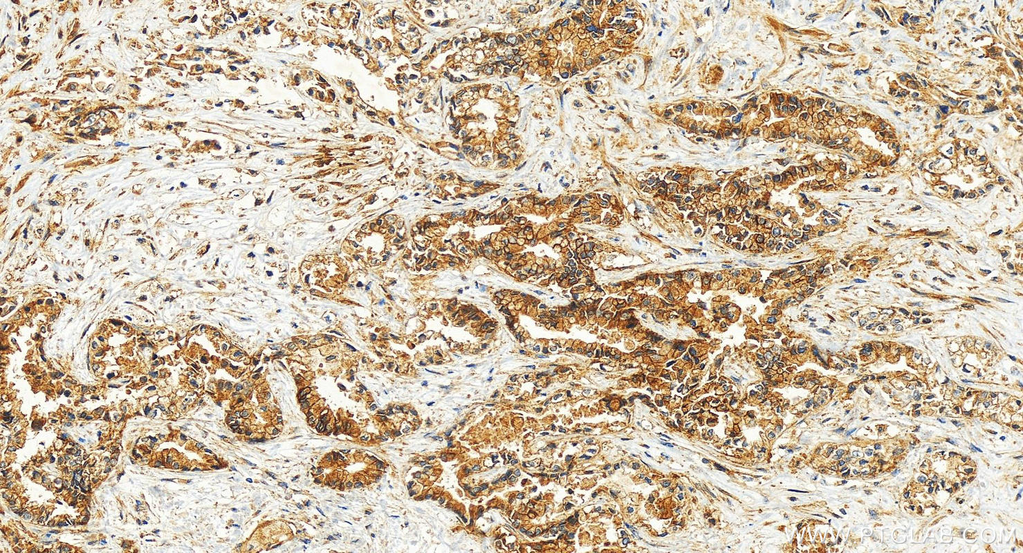 Immunohistochemistry (IHC) staining of human intrahepatic cholangiocarcinoma tissue using Integrin beta-8 Polyclonal antibody (29775-1-AP)